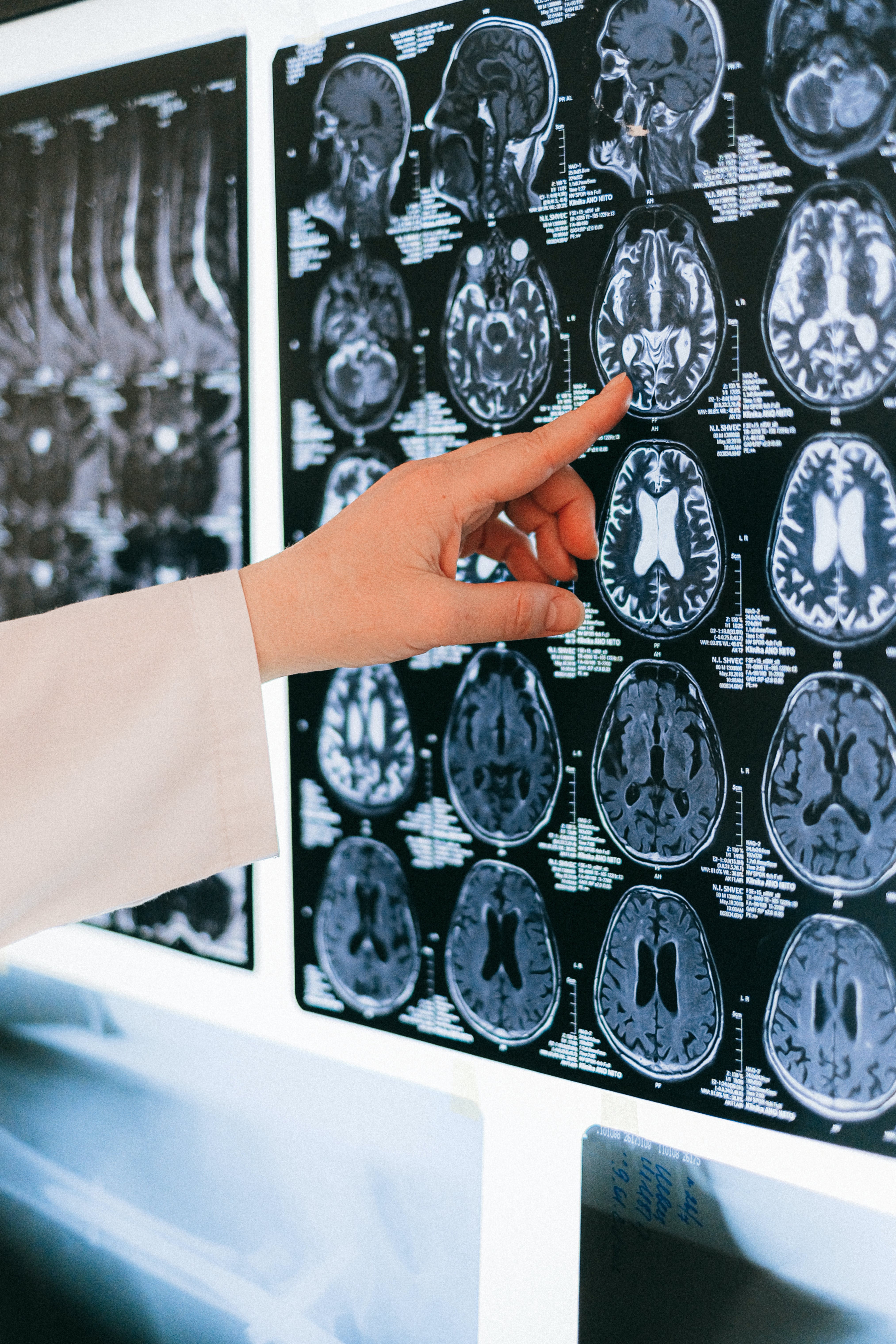 A doctor reviews a brain scan to signify the importance of rare disease research. 